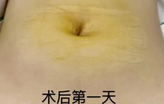 藏在肚脐里的微创黑科技｜经脐单孔腹腔镜，无痕康复双兼顾